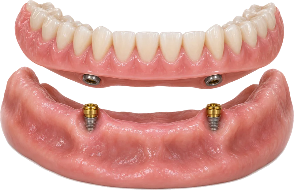 Snap-in over-denture on 2 Zimmer implants